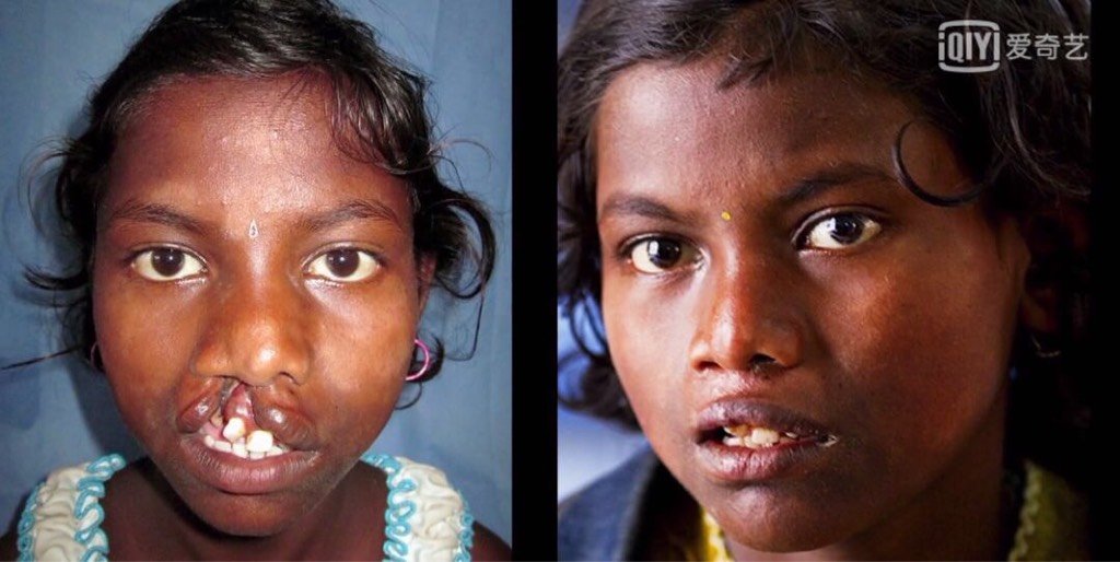 19楼 全球每700个新生儿中,就有一个是唇腭裂患者,在印度尤其高发.