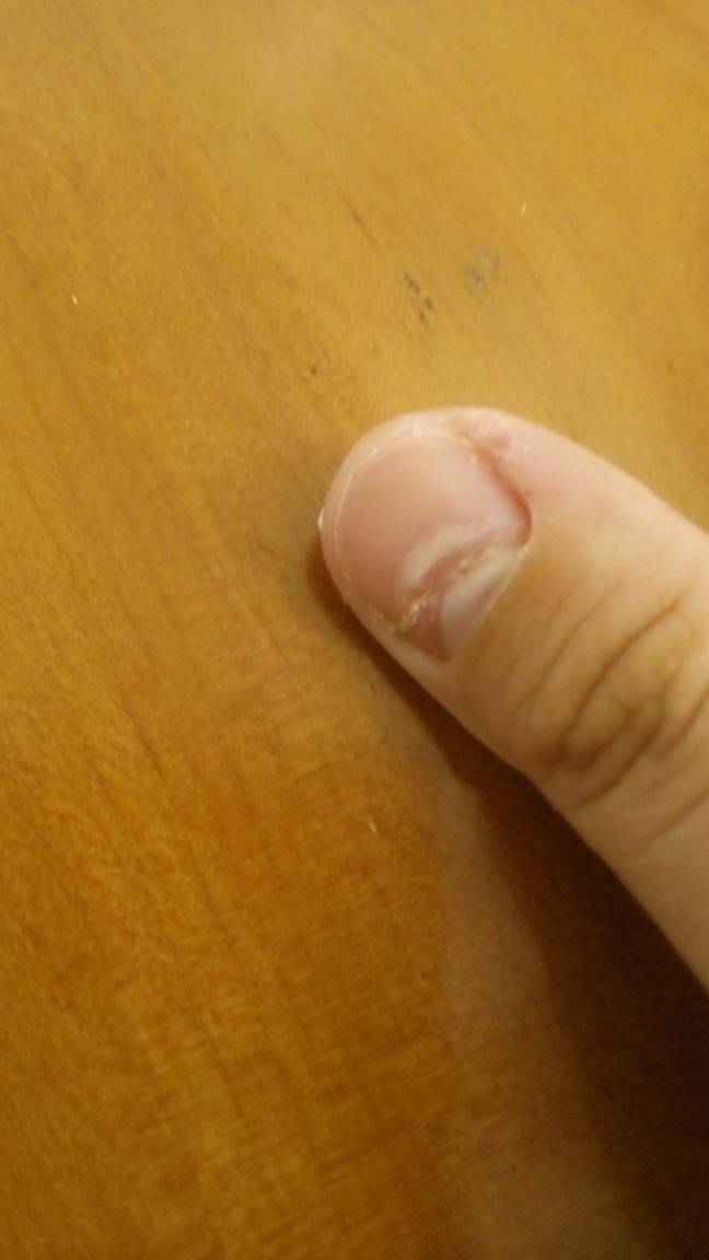 大拇指指甲凹下去,是怎么回事呢