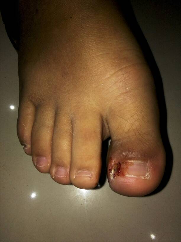 脚趾甲长到肉里去了,好痛怎么治疗?