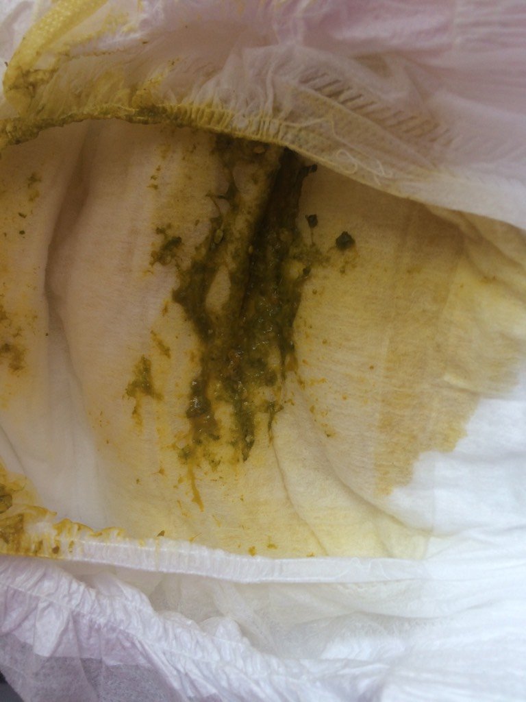 里面有奶瓣,之后拉的是黄色的鼻涕状,大便也比较 - 百度宝宝知道