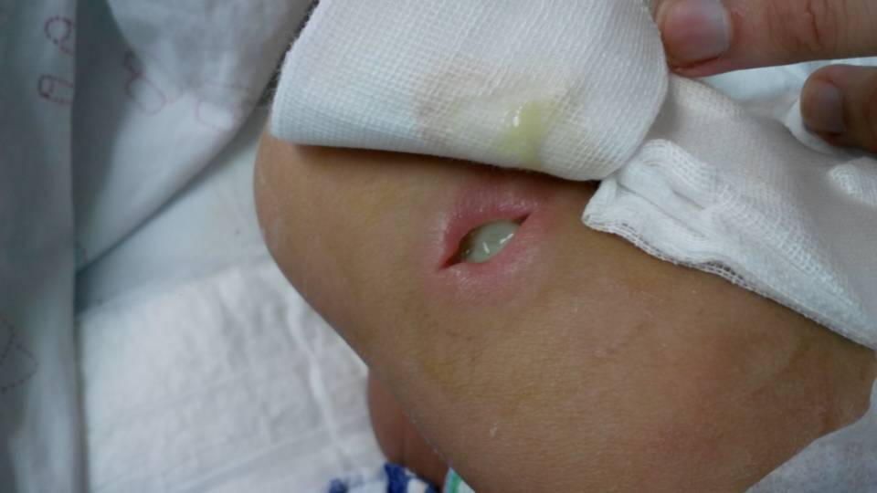 我弟的小孩5个月感冒发烧,在广西区妇幼检查得了菌血症,后又长脓包