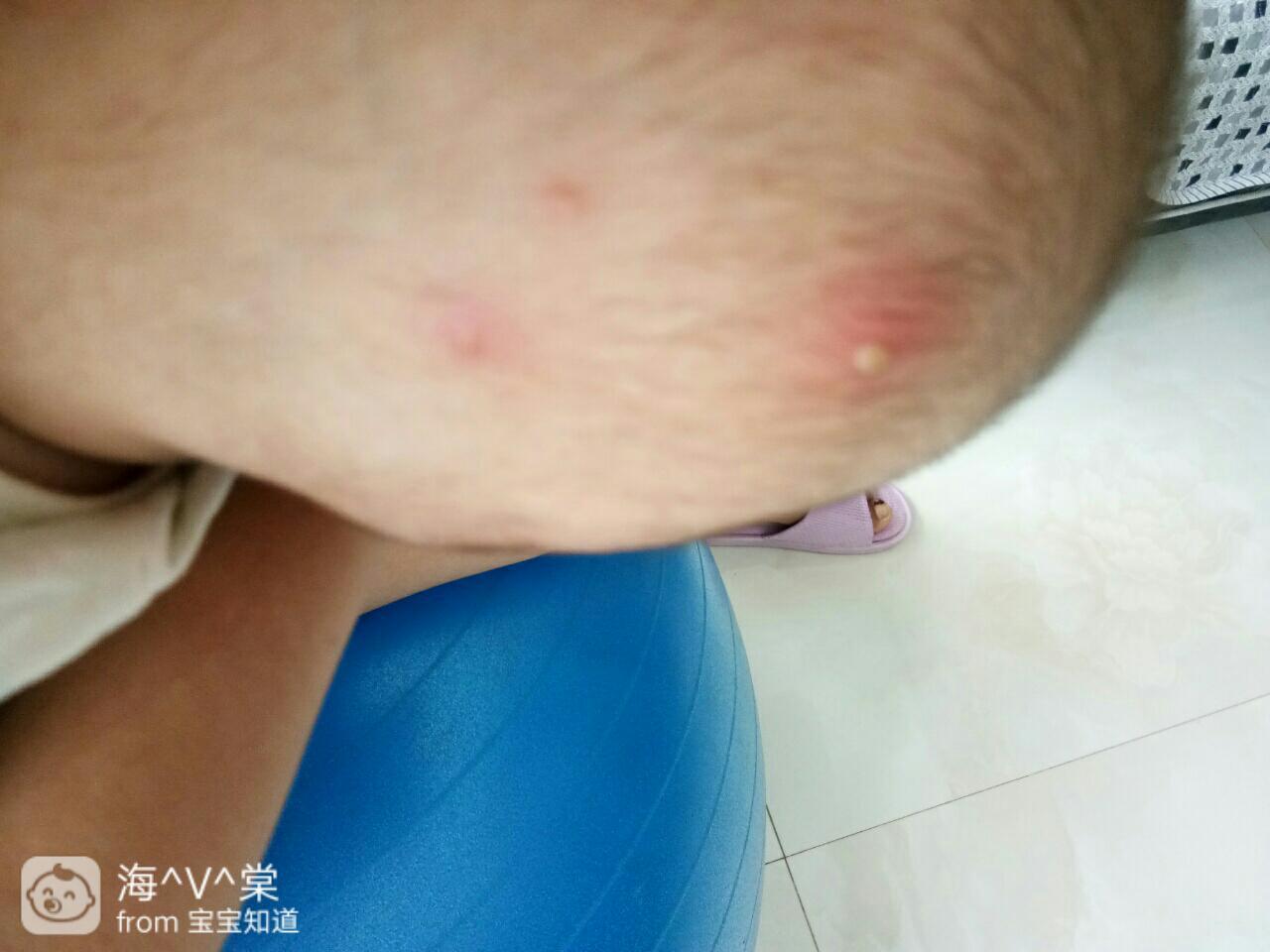 这是火疙瘩吗还是什么？有没有知道的宝妈，要不要紧啊？