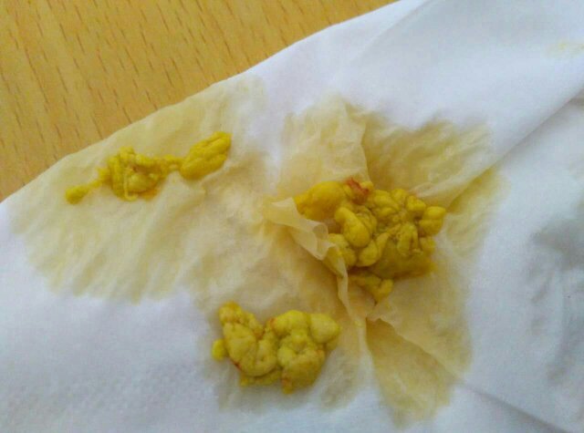 宝宝21天新生儿,吃母乳拉的屎像豆腐脑一样,求问这是否正常?