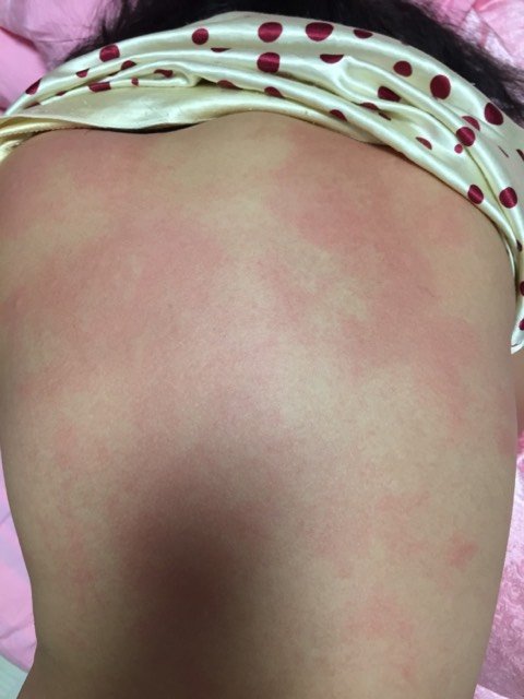 孩子8岁,后背上好像过敏了 请问咋弄?