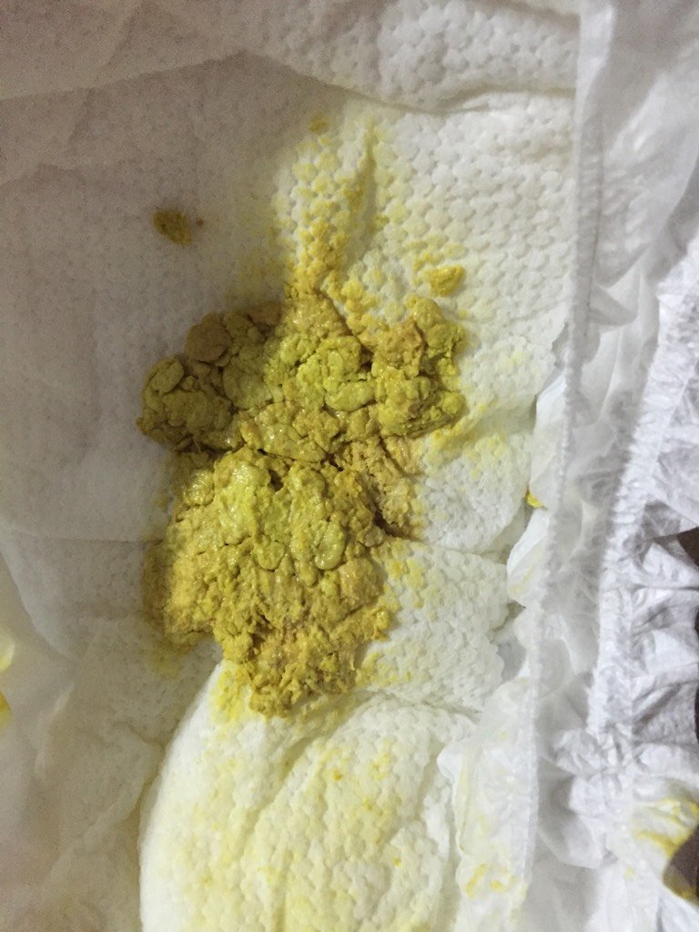 高,医生叫停几天母乳,第一天给奶粉吃后,宝宝拉屎就一小粒一小粒的