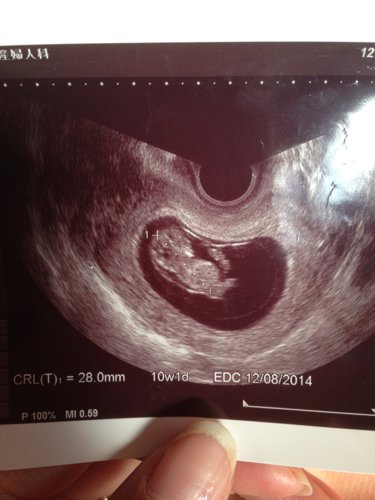 其他回答 病情分析: nt值是超声中测量妊娠10-14周胎儿颈项透明层厚度