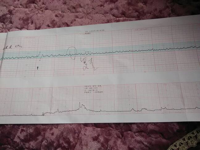 这一个胎心监护是什么意思,是宝宝缺氧还是?