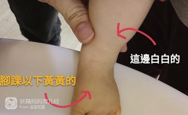 宝宝皮肤发黄色素沉淀和黄疸傻傻分不清楚辨别黄疸一招就够了