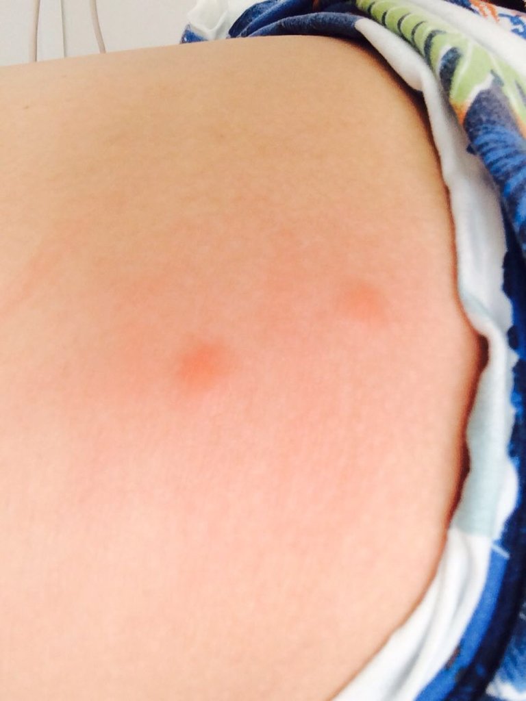 家里小孩的屁股上昨天起了这样的痘痘,请问大家这叫什么?