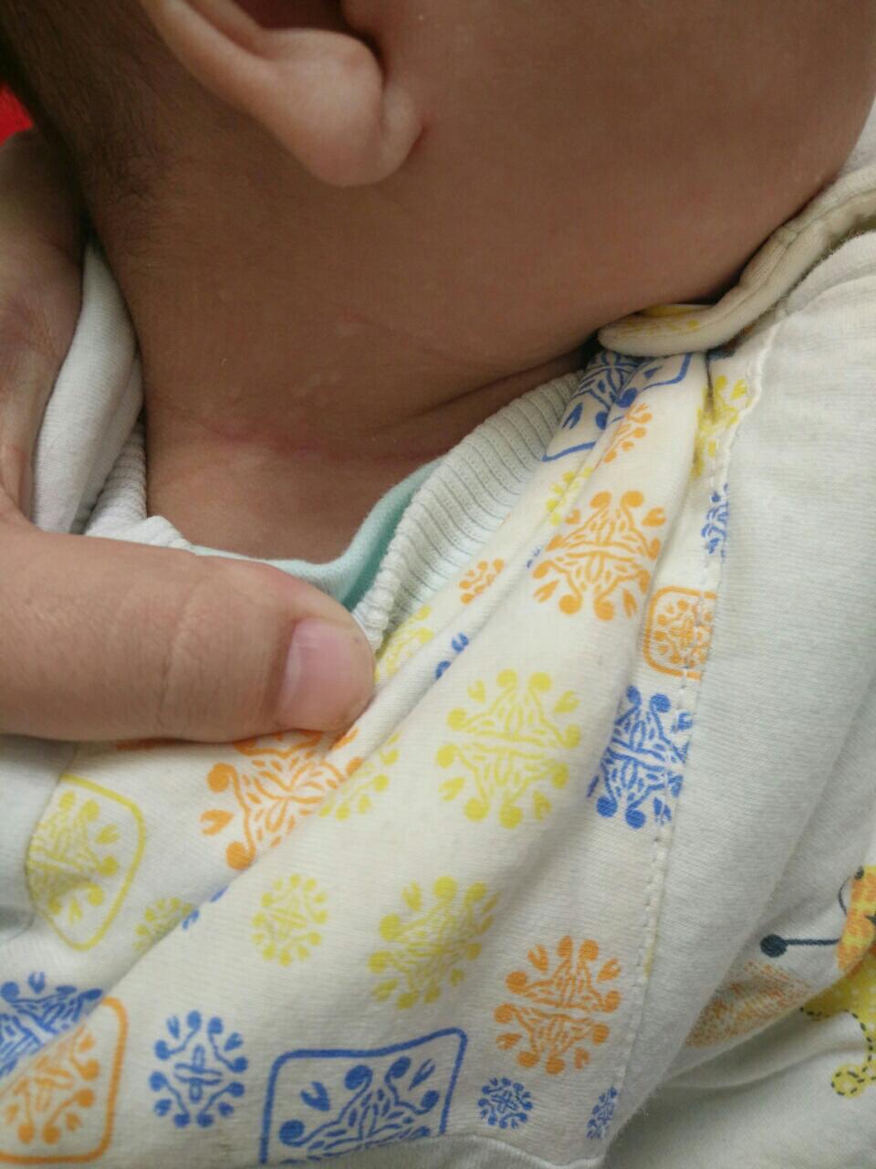宝宝脖子上有白色粒疹图片