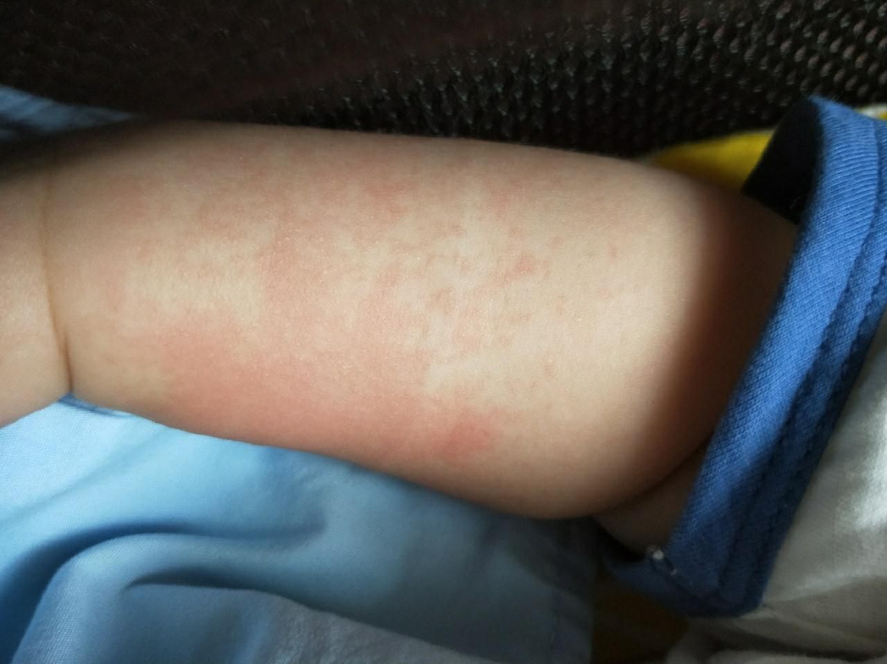 宝宝脖子和脸部上起了些小红疹,其他地方没有,这是过敏性湿疹吗?