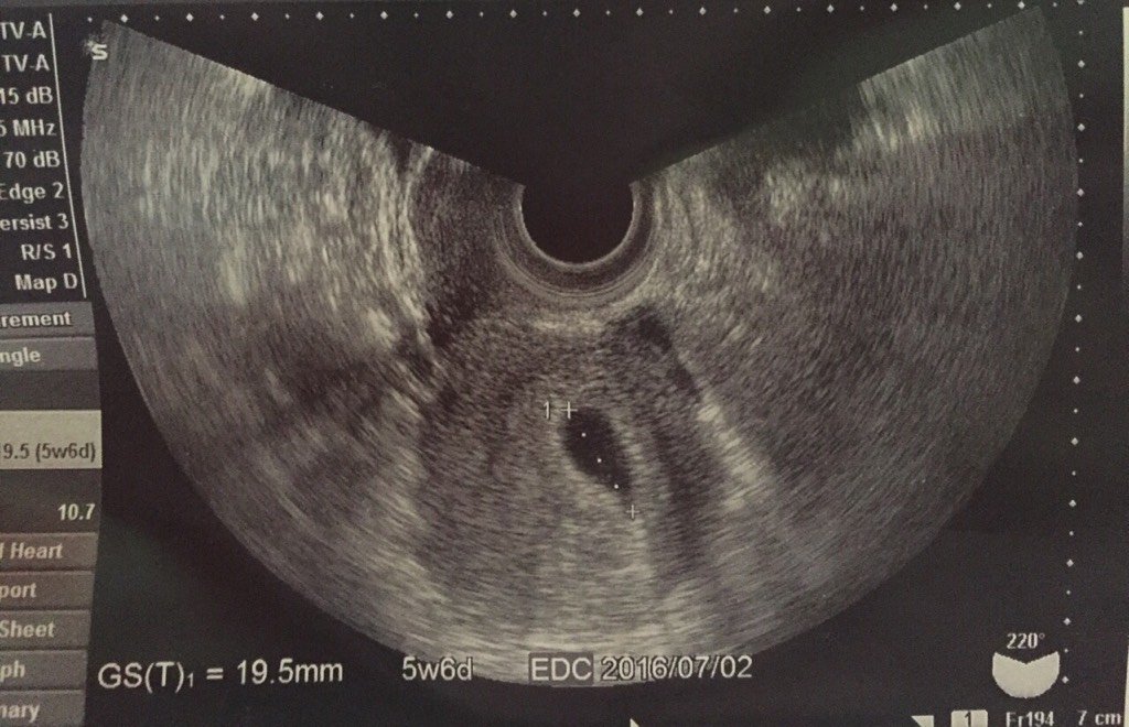 怀孕五周六天,早晨少量出血,请问看图正常吗?