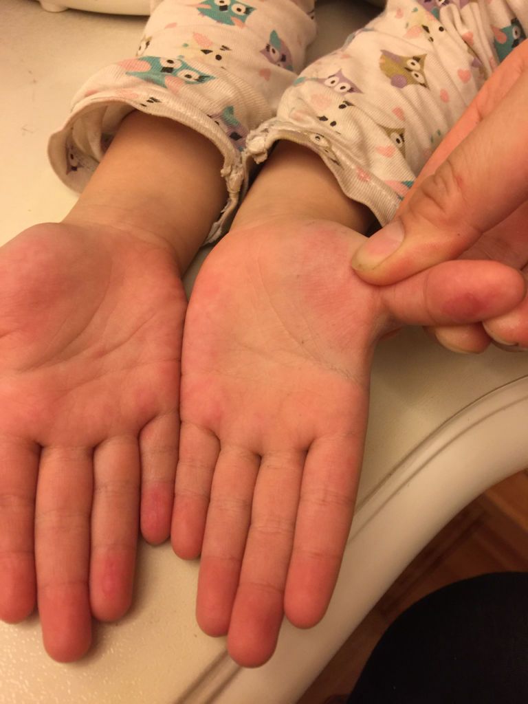 宝宝手心发红蜕皮,还很疼,是怎么回事呢