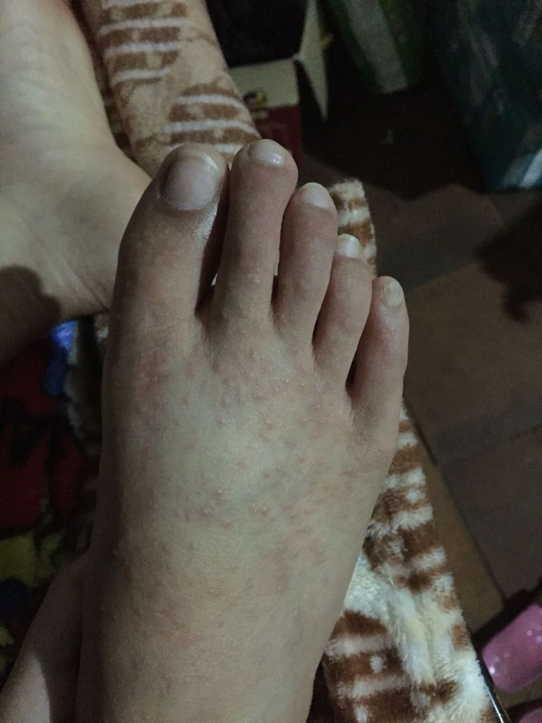 月子手脚起小水泡而且还很痒 越长越多