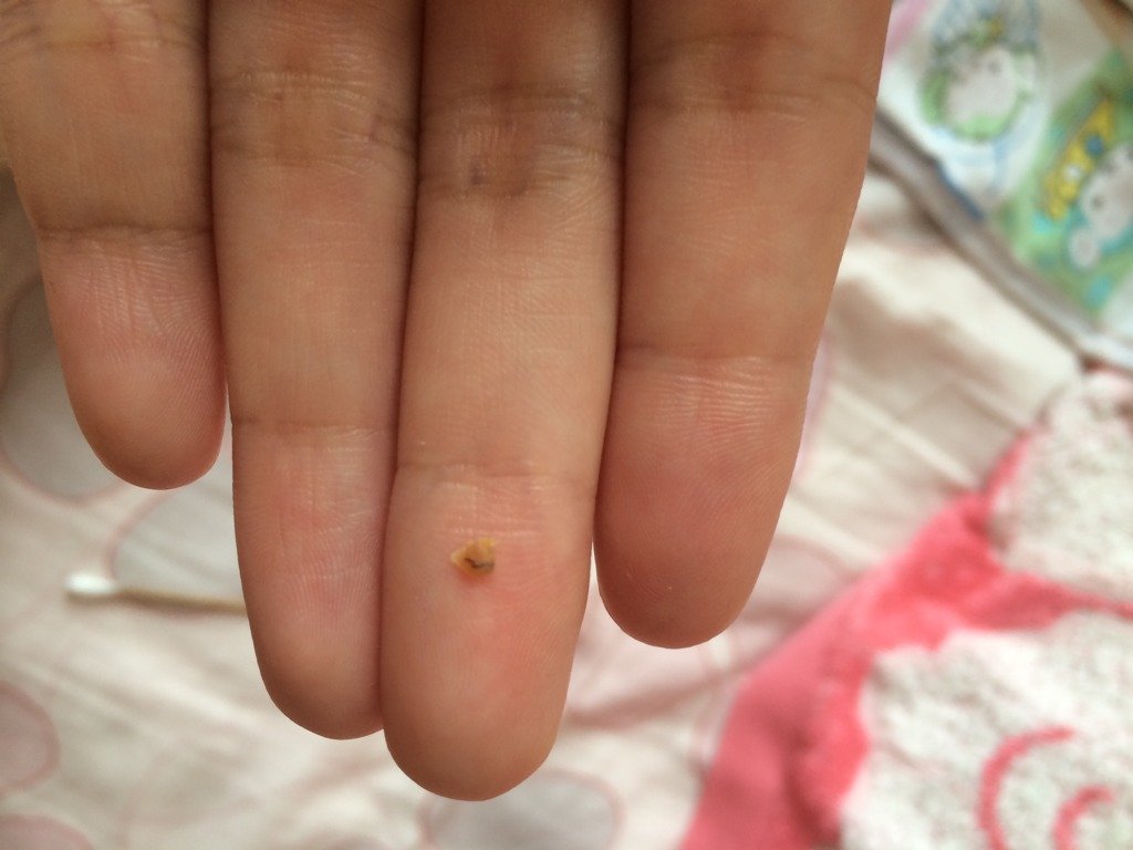 宝宝耳屎这样正常吗