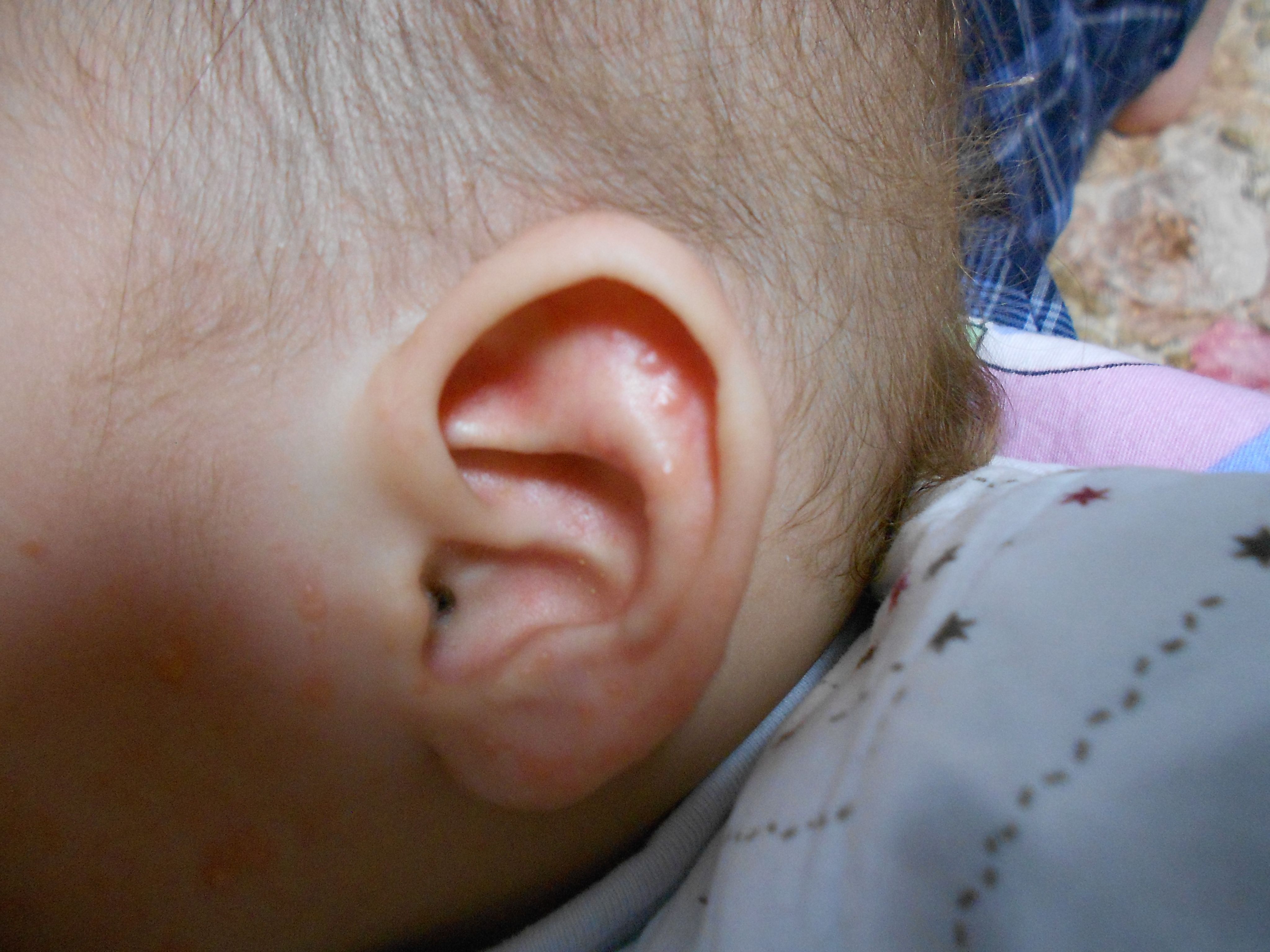 婴儿额头上有小白疙瘩（这6种疹子宝宝最容易患上）-幼儿百科-魔术铺