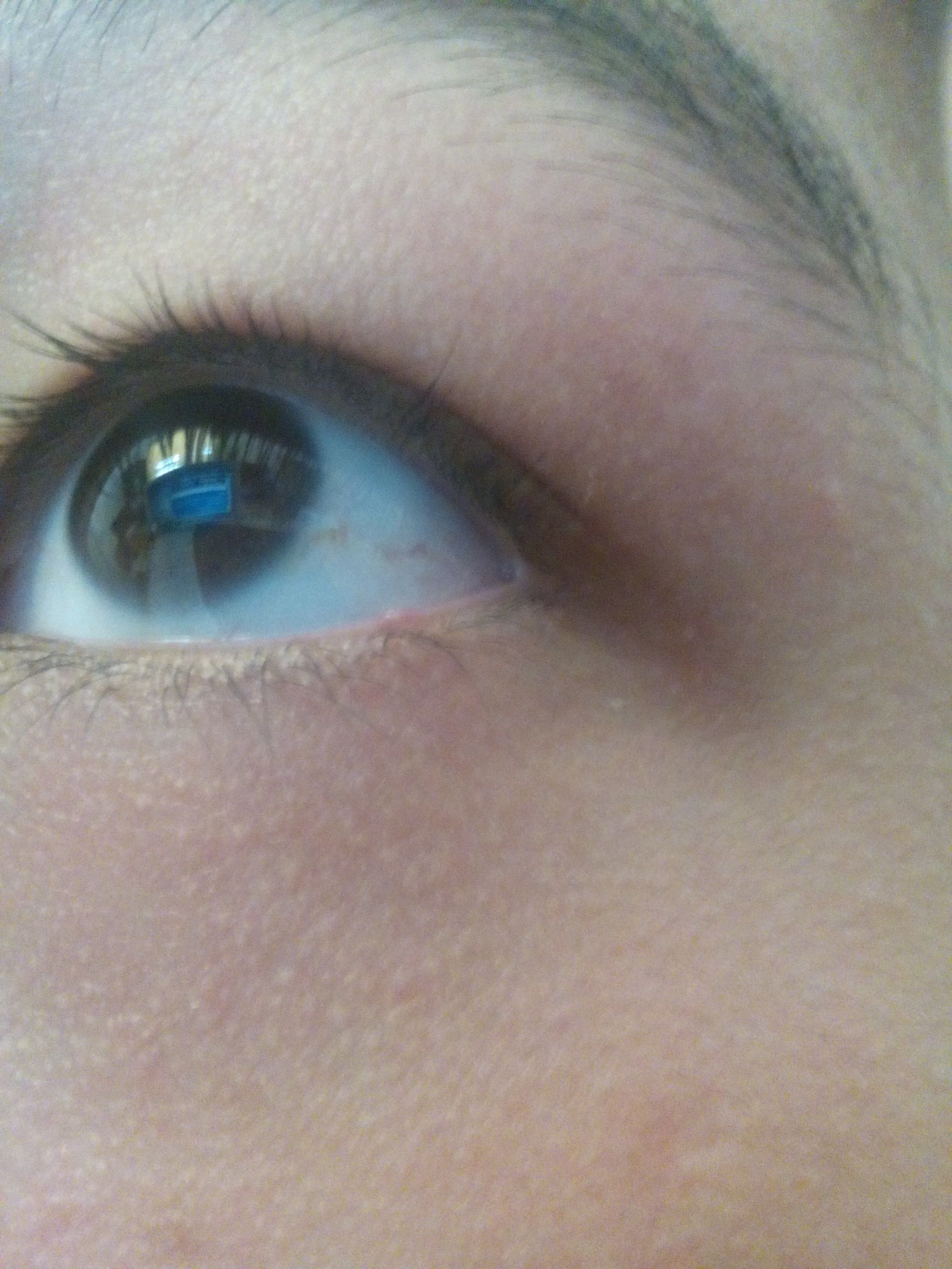 下眼睑上长了个小颗粒不知道是什么