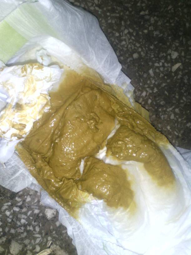 五个月宝宝混合喂养拉这个便便正常么