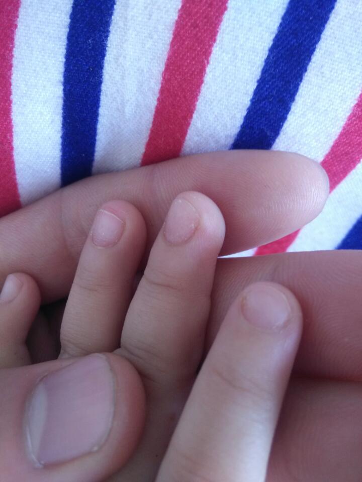 孩子指甲凹凸不平图片图片