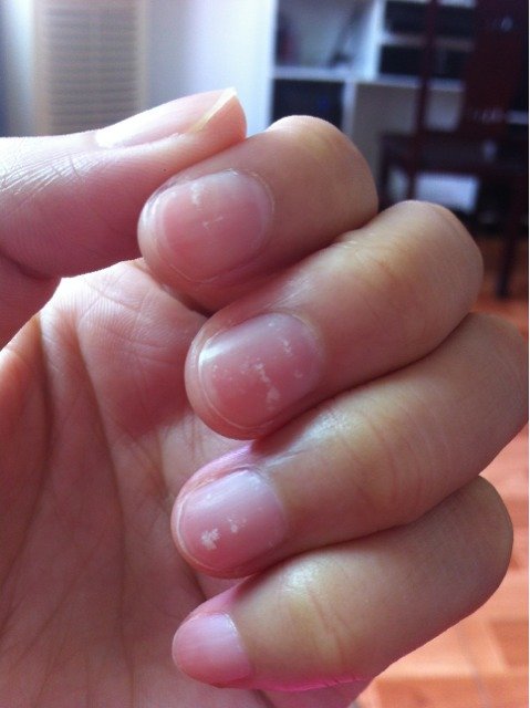 怀孕后指甲里好多这种白点是什么原因?