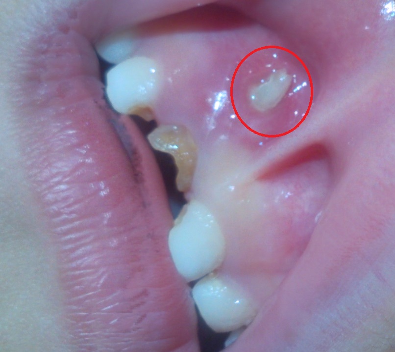 7岁小孩乳牙牙根从牙龈根部露出,这是怎么回事?