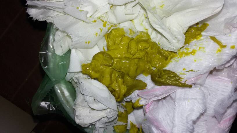 为您推荐: 其他回答 你好,看图片像是消化不良引起的宝宝大便不好.