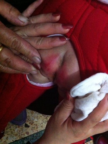 屁股已经红成这样!请问那位好心专家能够帮忙! - 百度宝宝知道