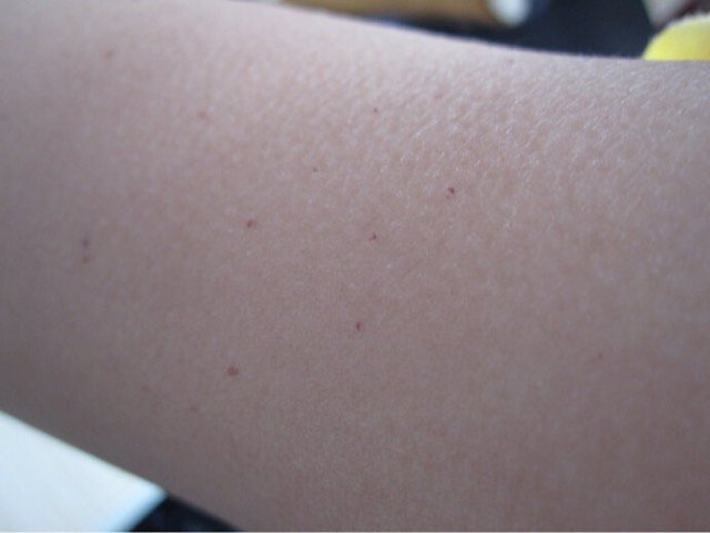 看图片教您如何正确识别宝宝的红疹