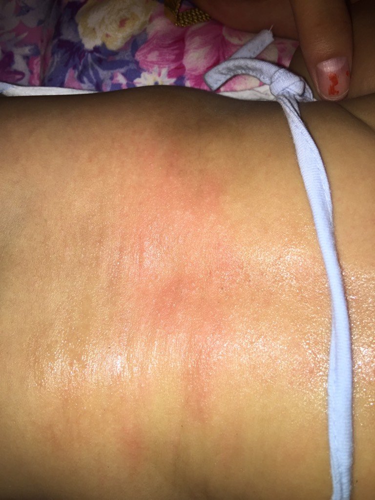 后背起的什么,我给买的痱子膏我也不知道是不是痱子 - 百度宝宝知道