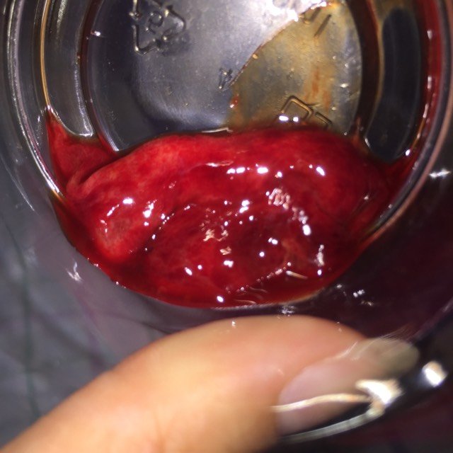 宫外孕会不会自然流产?求答案