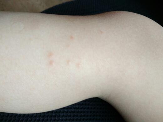三岁宝宝腿上身上起了很多粉嫩色的痘痘,腿上比较多一点