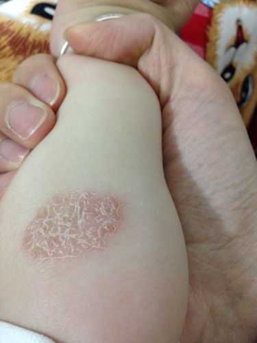 宝宝现在10个月了,大概两个月前手上有个小红斑,去看了医生,说是湿疹