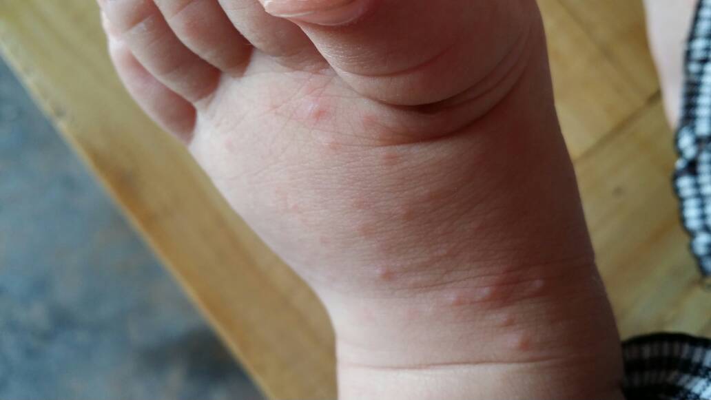 宝宝八个月,这是什么疹子?脚上很多,身上少量 急