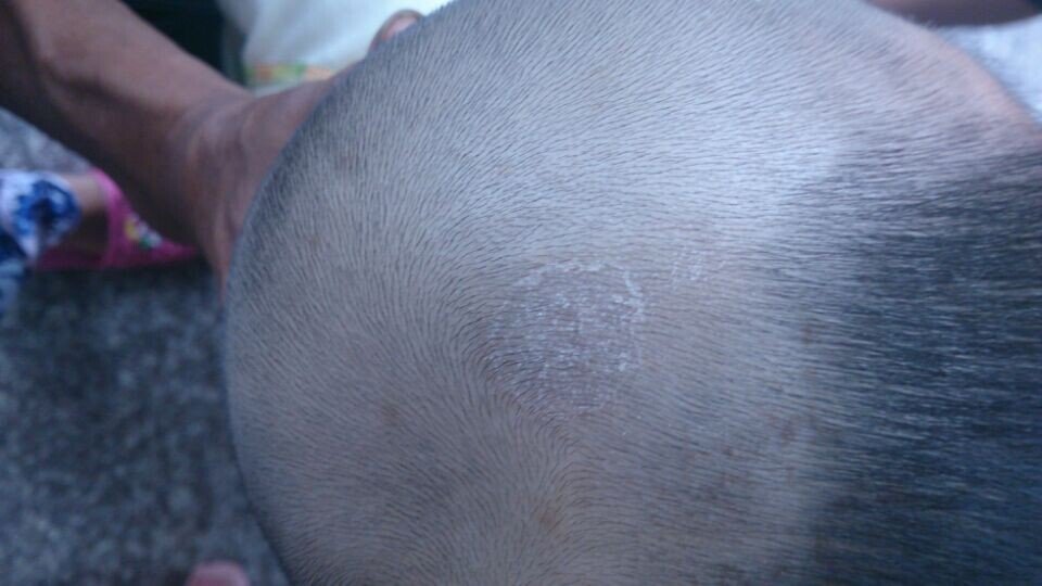 8个月宝宝头上白色鳞状头屑