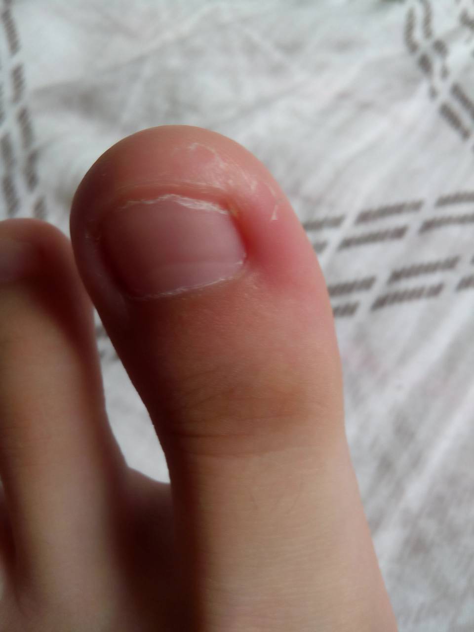 小孩指甲长到肉里怎么办