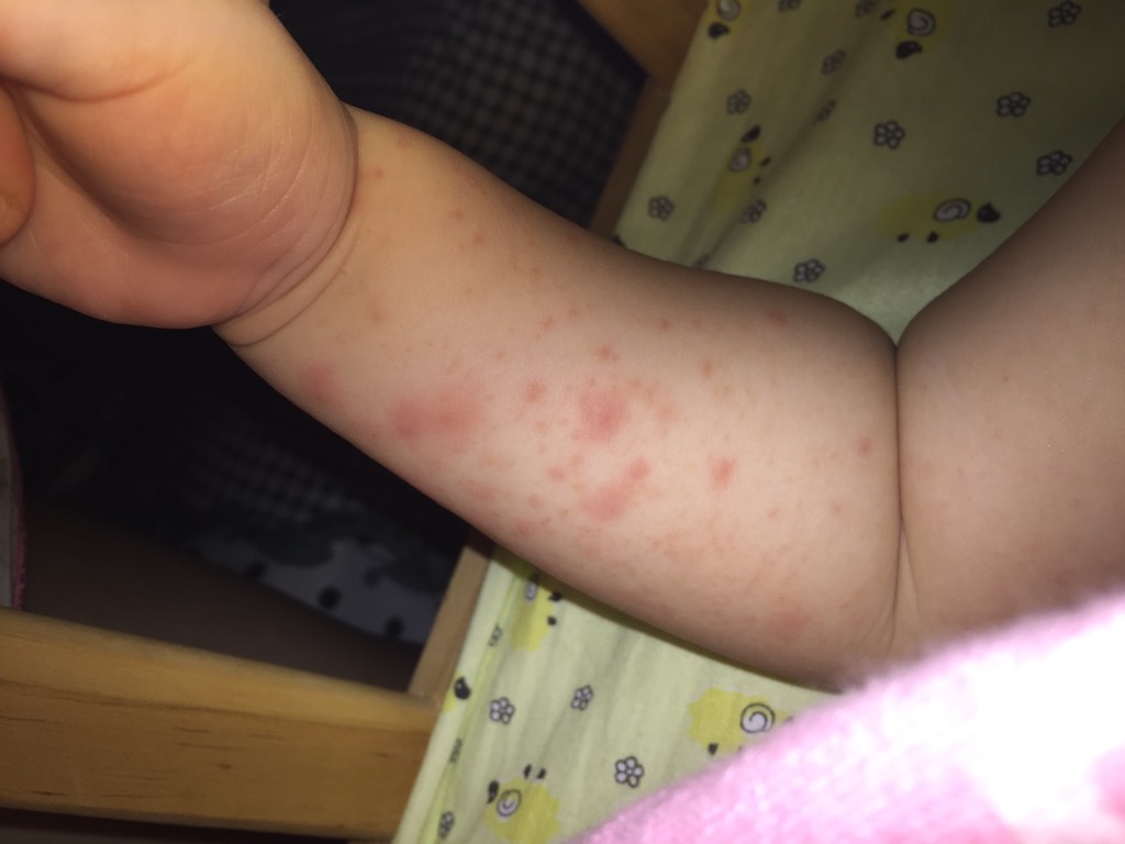 一岁宝宝身上起红疹子图片