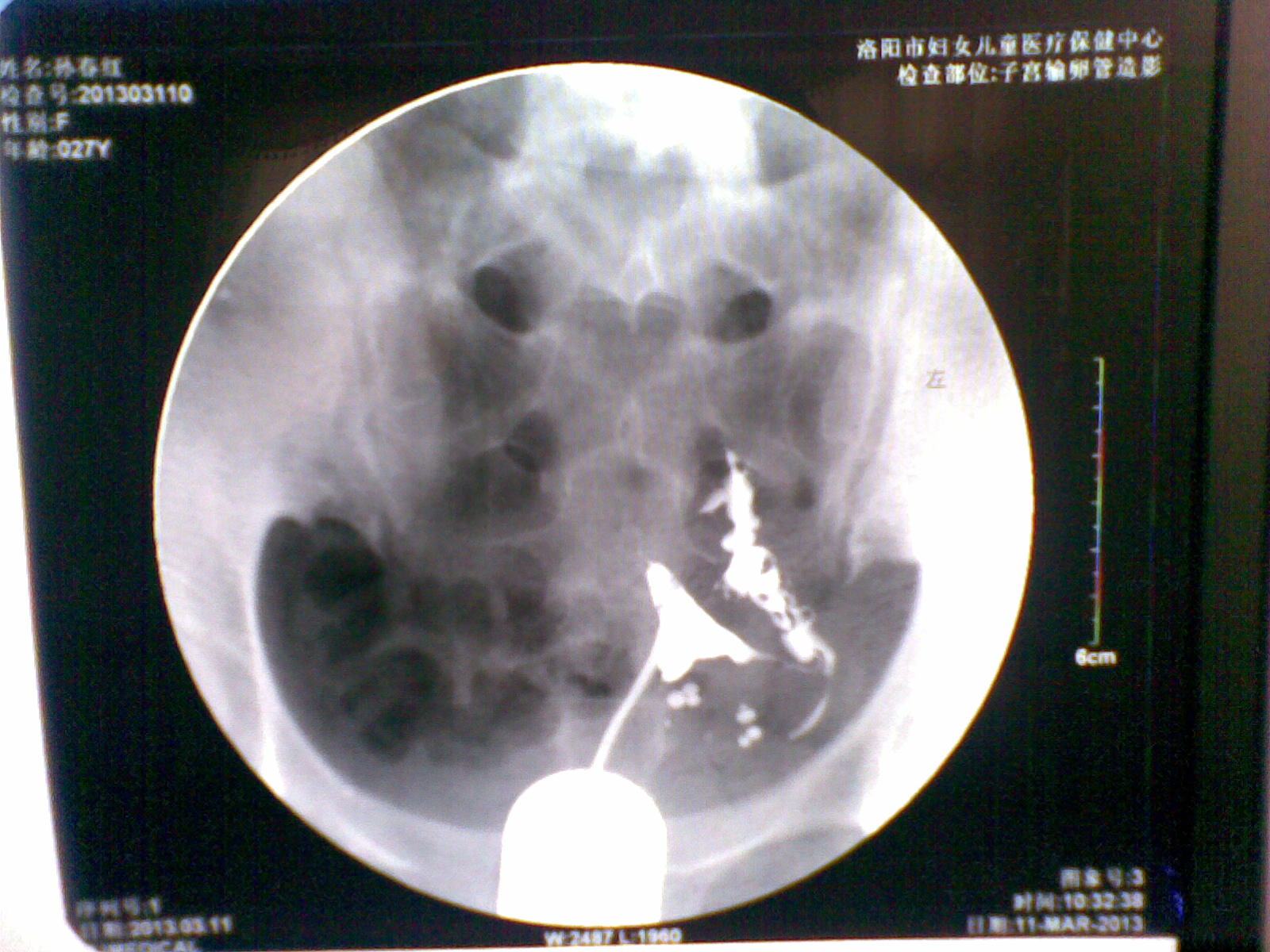 【腹腔镜篇】输卵管妊娠保守手术 - 宫腔镜 - 上海世音光电仪器有限公司