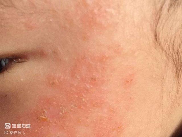 婴儿湿疹,那哺乳期妈妈有哪些不能吃呢?