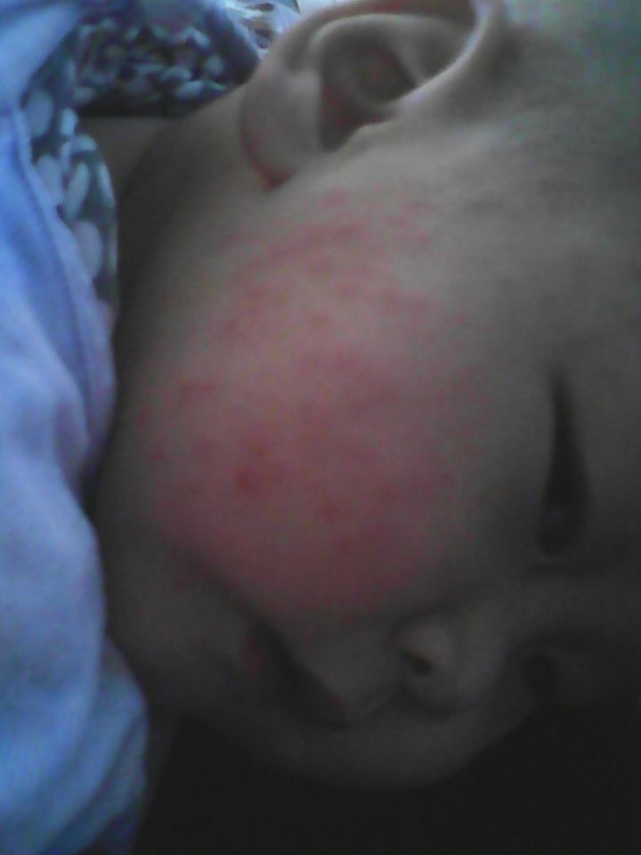 宝宝一岁4个月了,脸上突然长了好多红色的小疙瘩