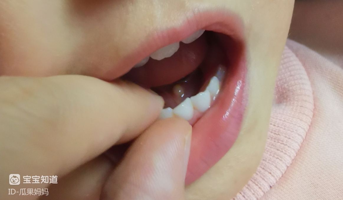 孩子舌头颗粒透明小泡图片