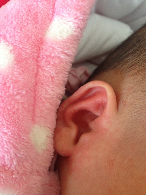宝宝耳朵有红血点图片图片