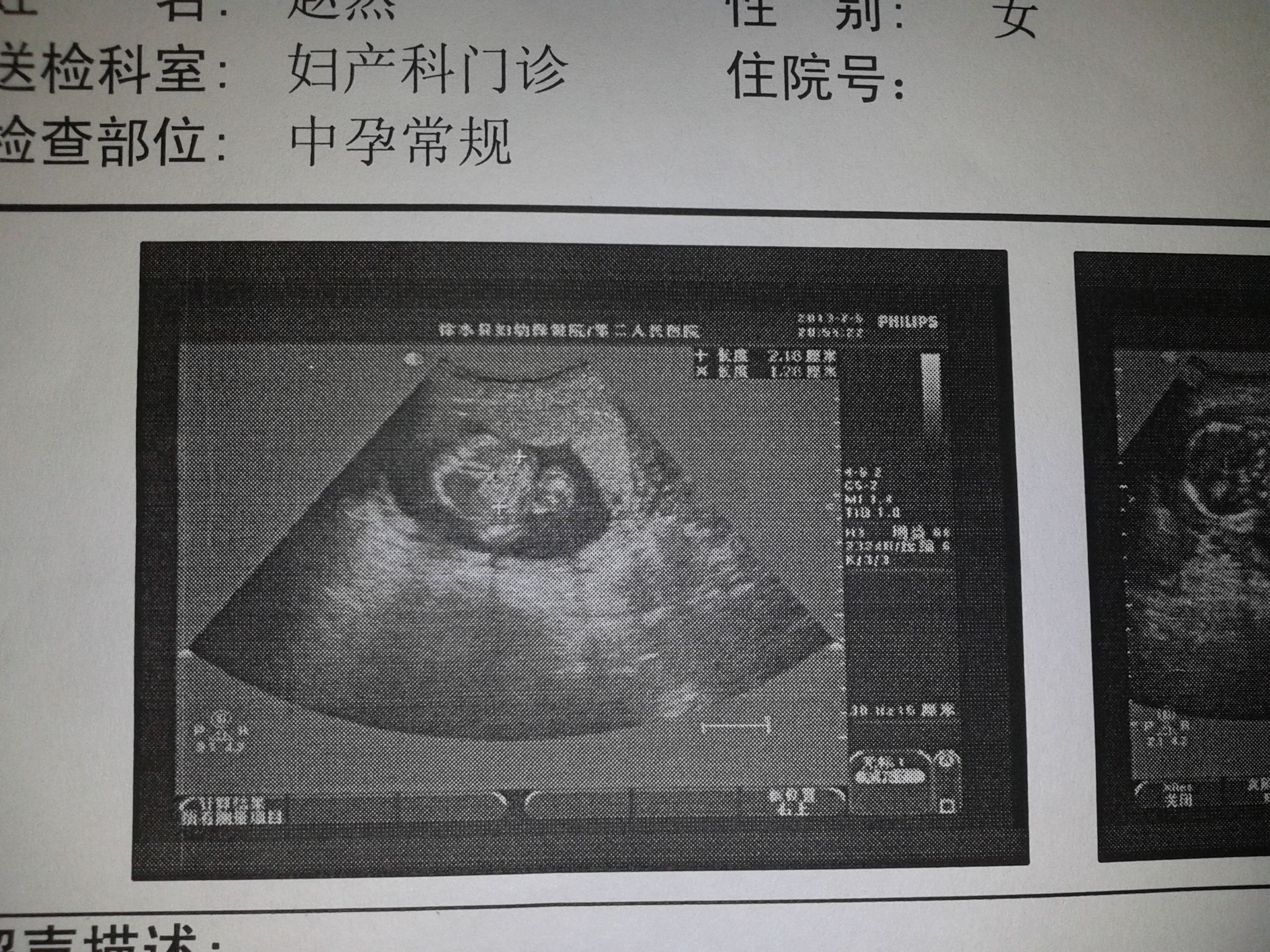 孕7月引产术后1周，复查；和引产后14天复查 - 百度宝宝知道