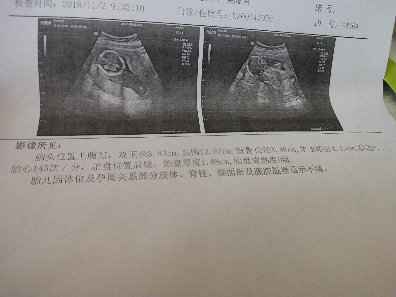 16周听胎心的位置图片图片