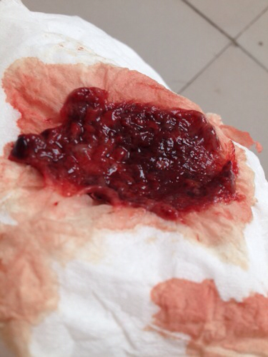 怀孕40多天,小腹阵痛,特别痛,完后流出来的东西,这是怎么回事啊?