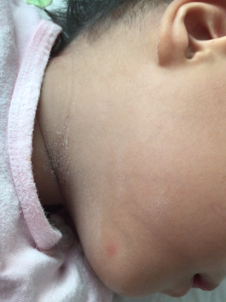 一岁半宝宝脖子出了好多湿疹,大片的红,现在开始蜕皮,脖子下面也有