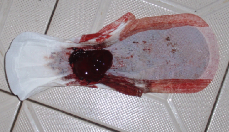 月经里有血块跟肉似的图片