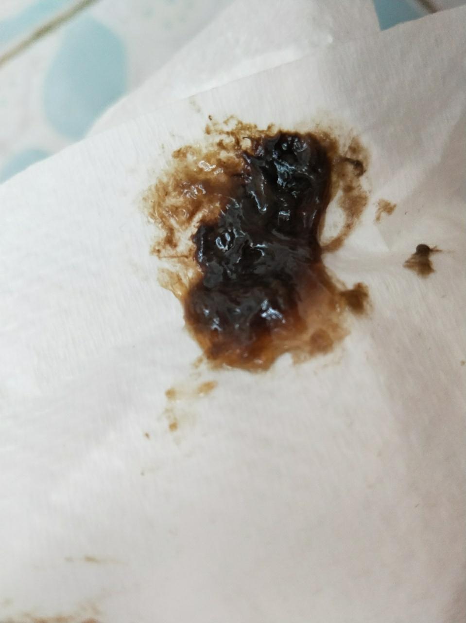 孕35周,最近一段时间总有一些咖啡色分泌物出现,请问这是怎么回事?