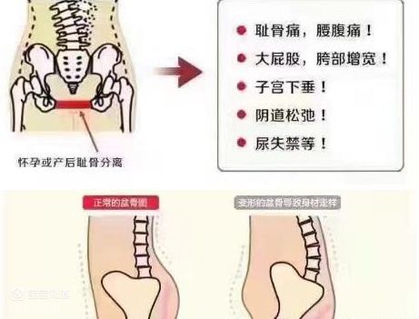产后越来越胖如何快速产后修复原来骨盆聚合才是关键