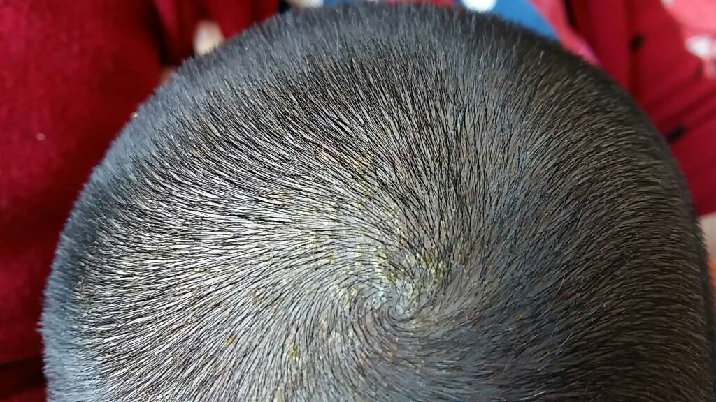 孩子刚满月头顶上张了好多黄痂,像流浓,怎么回事啊