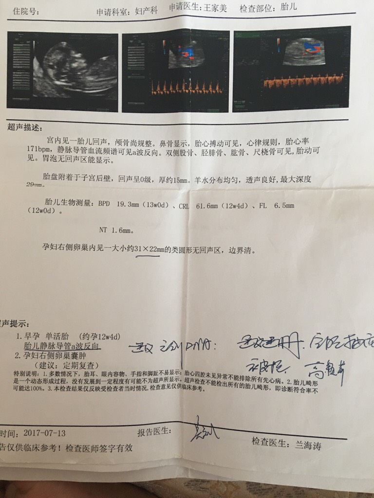 胎儿静脉导管a波反向